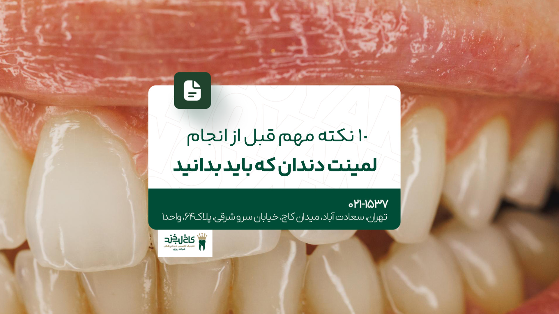 ۱۰ نکته مهم قبل از انجام لمینت دندان که باید بدانید