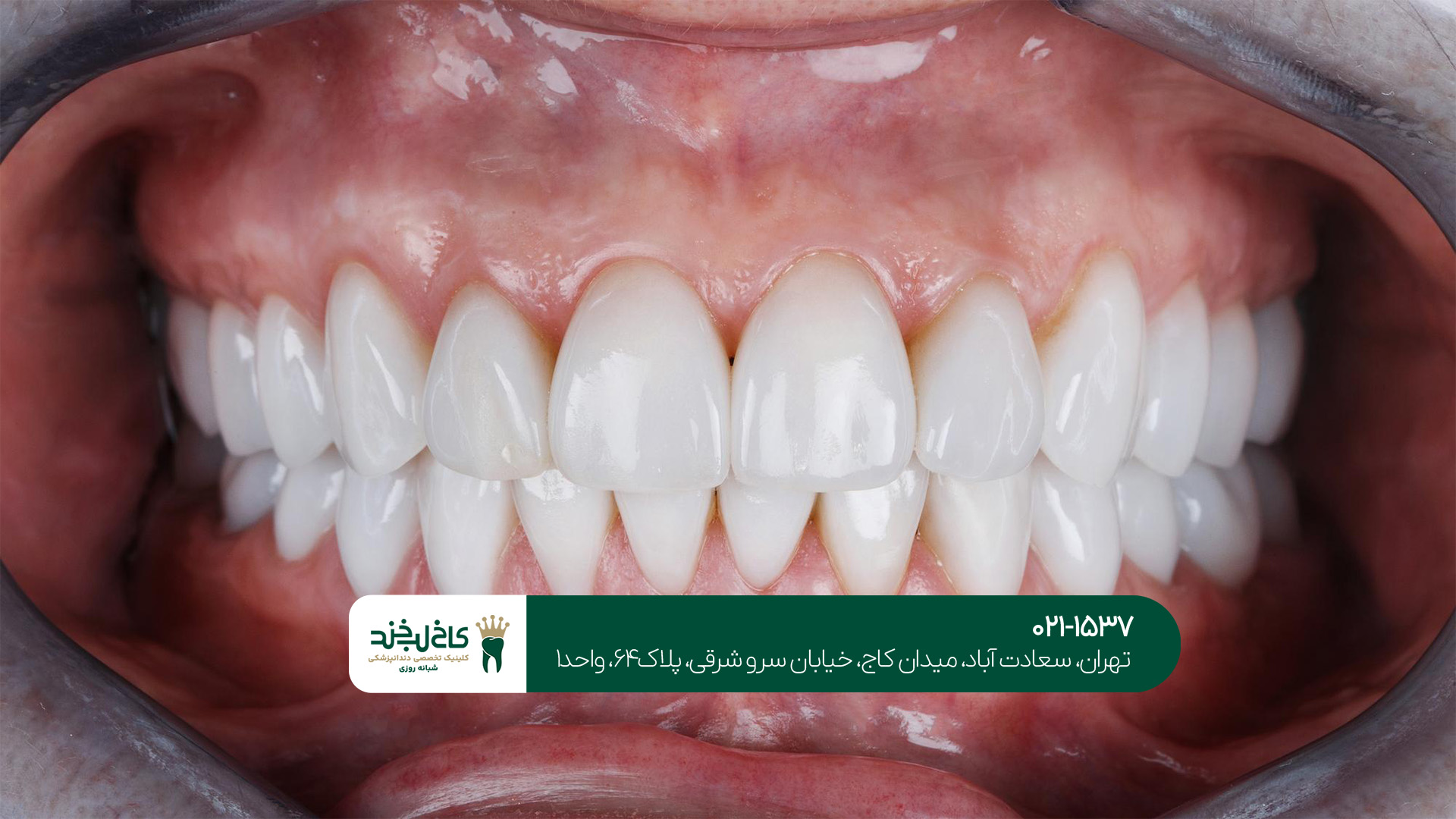 شرایط لازم برای انجام لمینت دندان: آیا شما فرد مناسبی هستید؟
