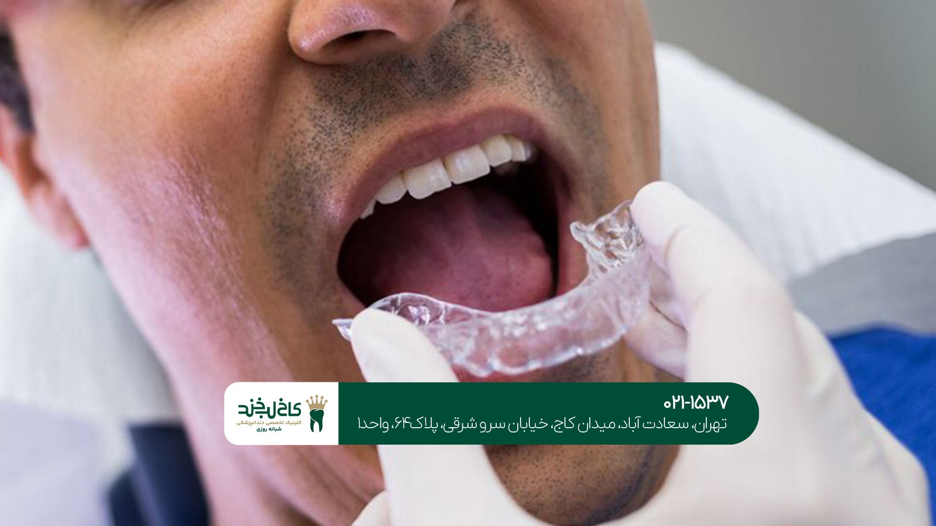 چگونه عمر لمینت دندان را افزایش دهیم؟!