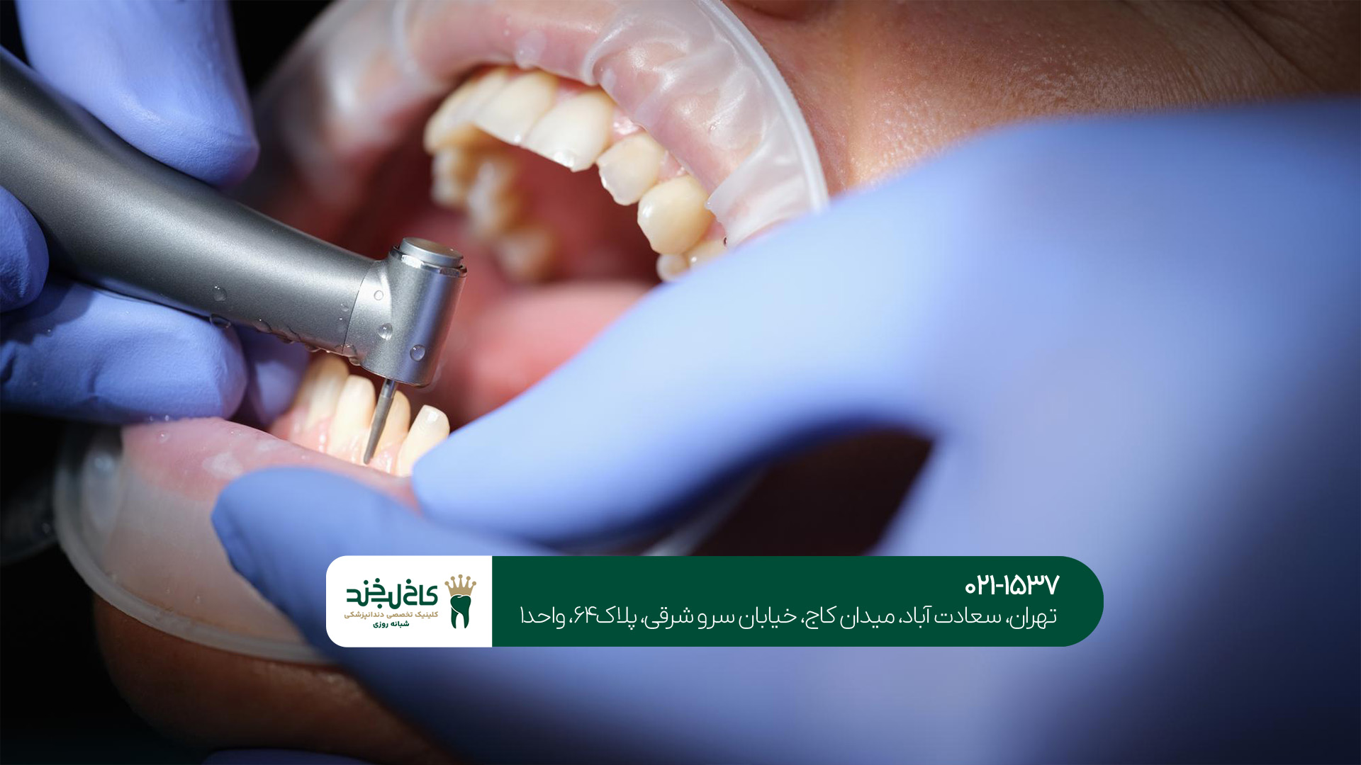 انواع لمینت دندان: سرامیکی یا کامپوزیتی