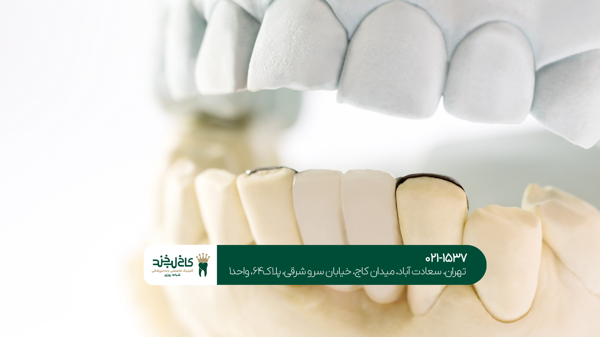 لمینت دندان برای چه افرادی مناسب است؟!