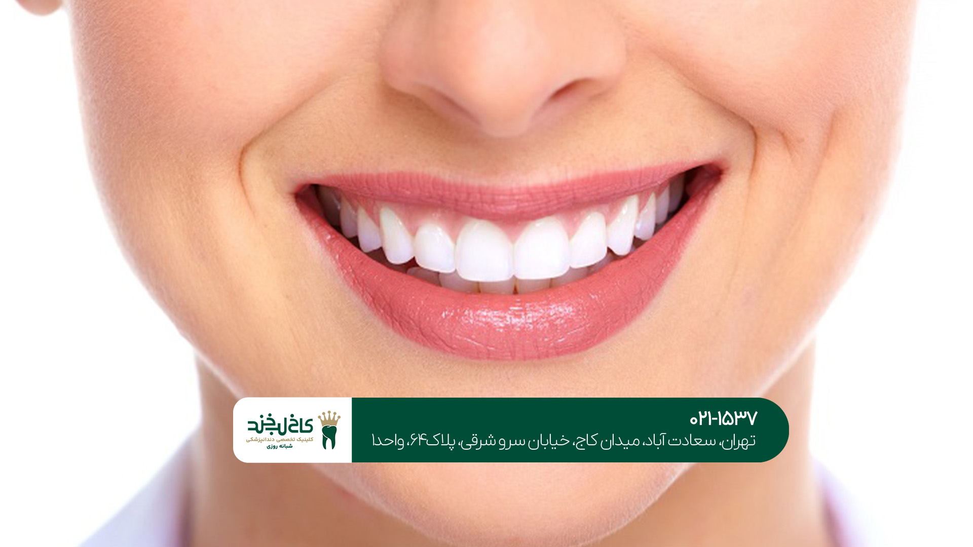 بعد از لمینت دندان چه کارهایی را نباید انجام دهیم؟!