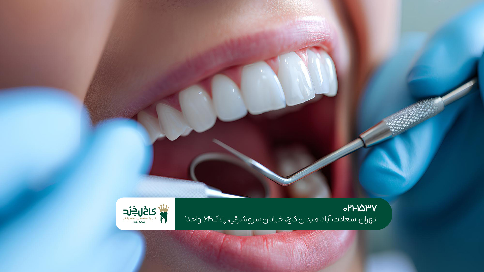 تفاوت در مراقبت های پس از نصب لمینت ونیر یا کامپوزیت ونیر