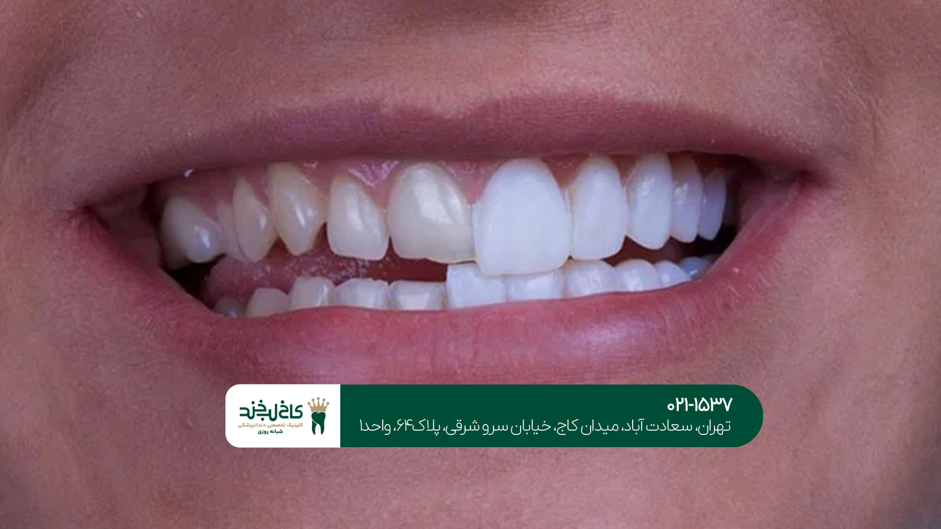 5 مزیت اصلی لمینت دندان 