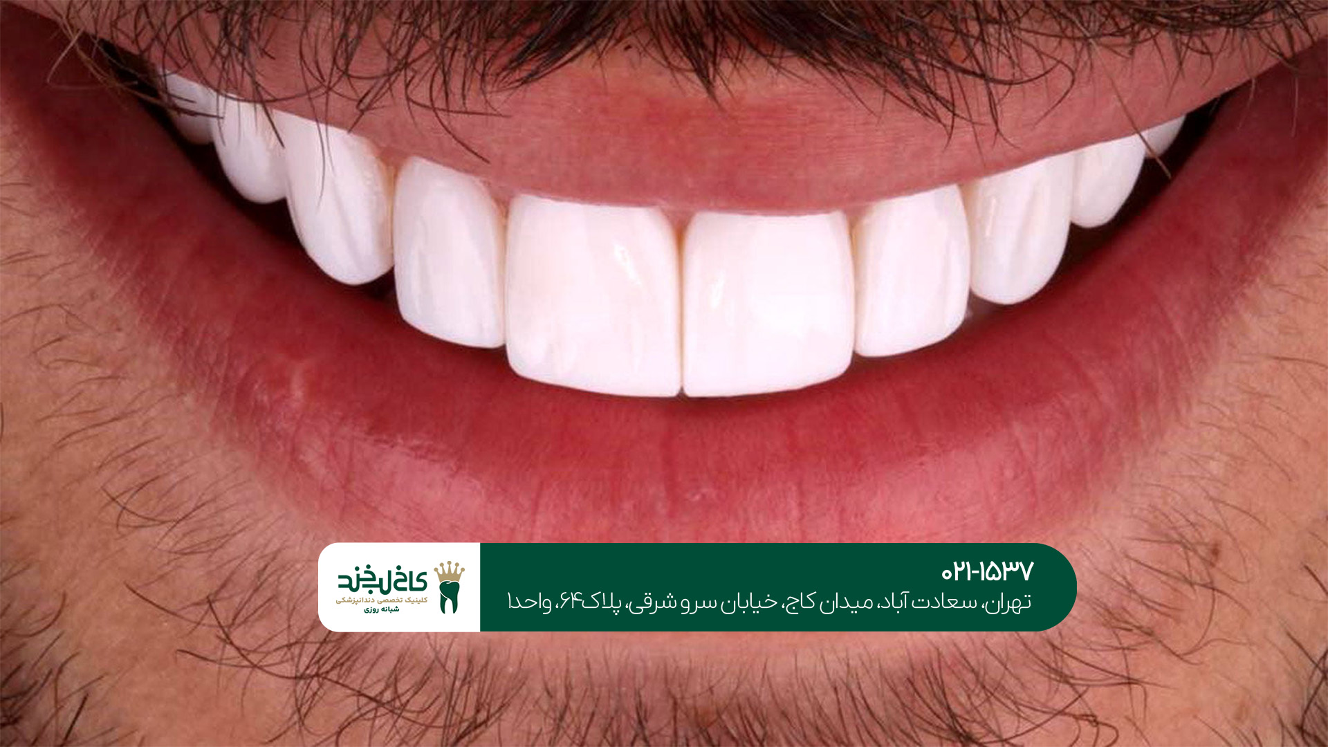 5 مزیت اصلی لمینت دندان 