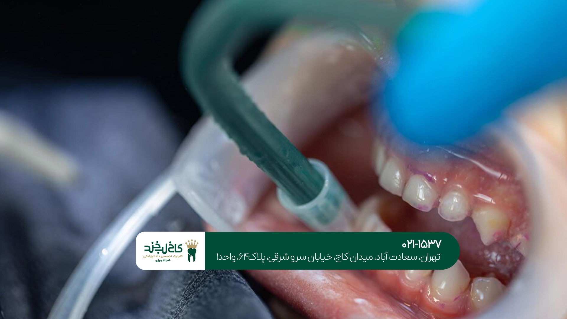 بهترین زمان برای جرم‌گیری دندان کی است؟!