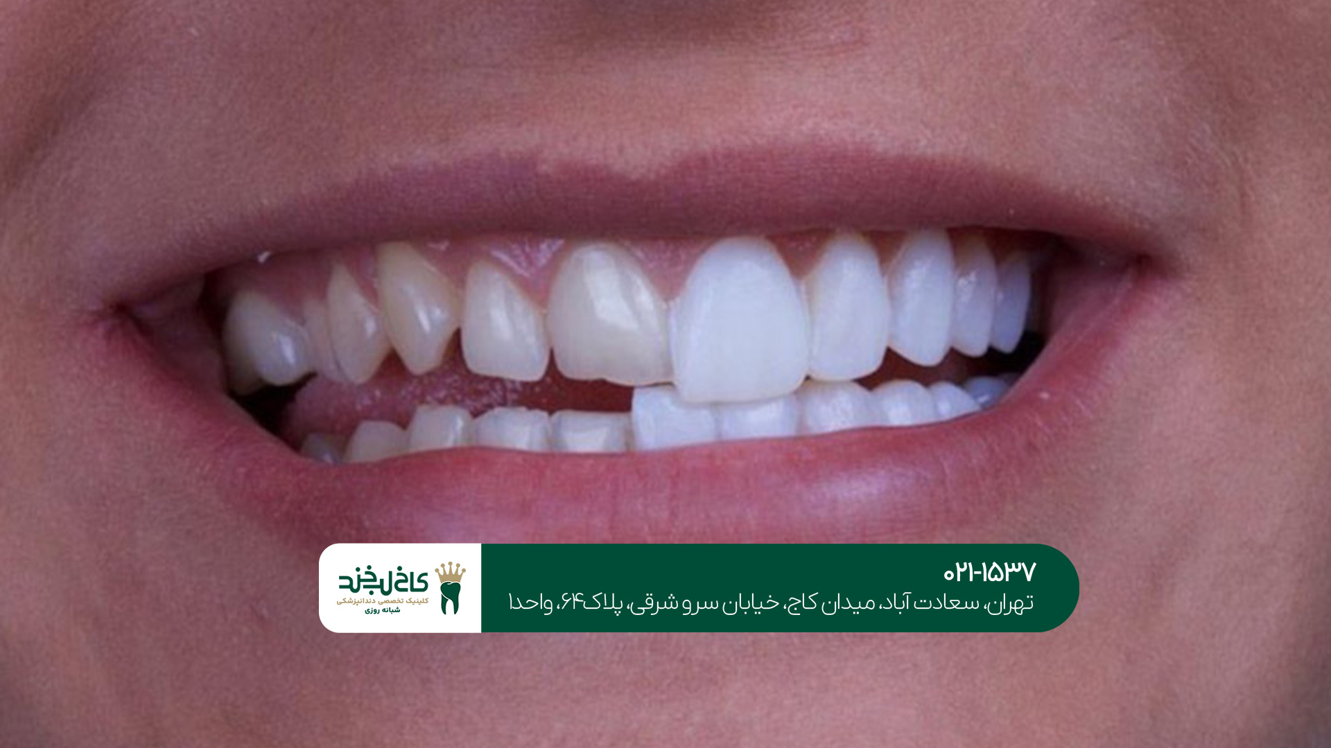 یک نکته مهم: روش اجرا در کاپوزیت و لمینت دندان
