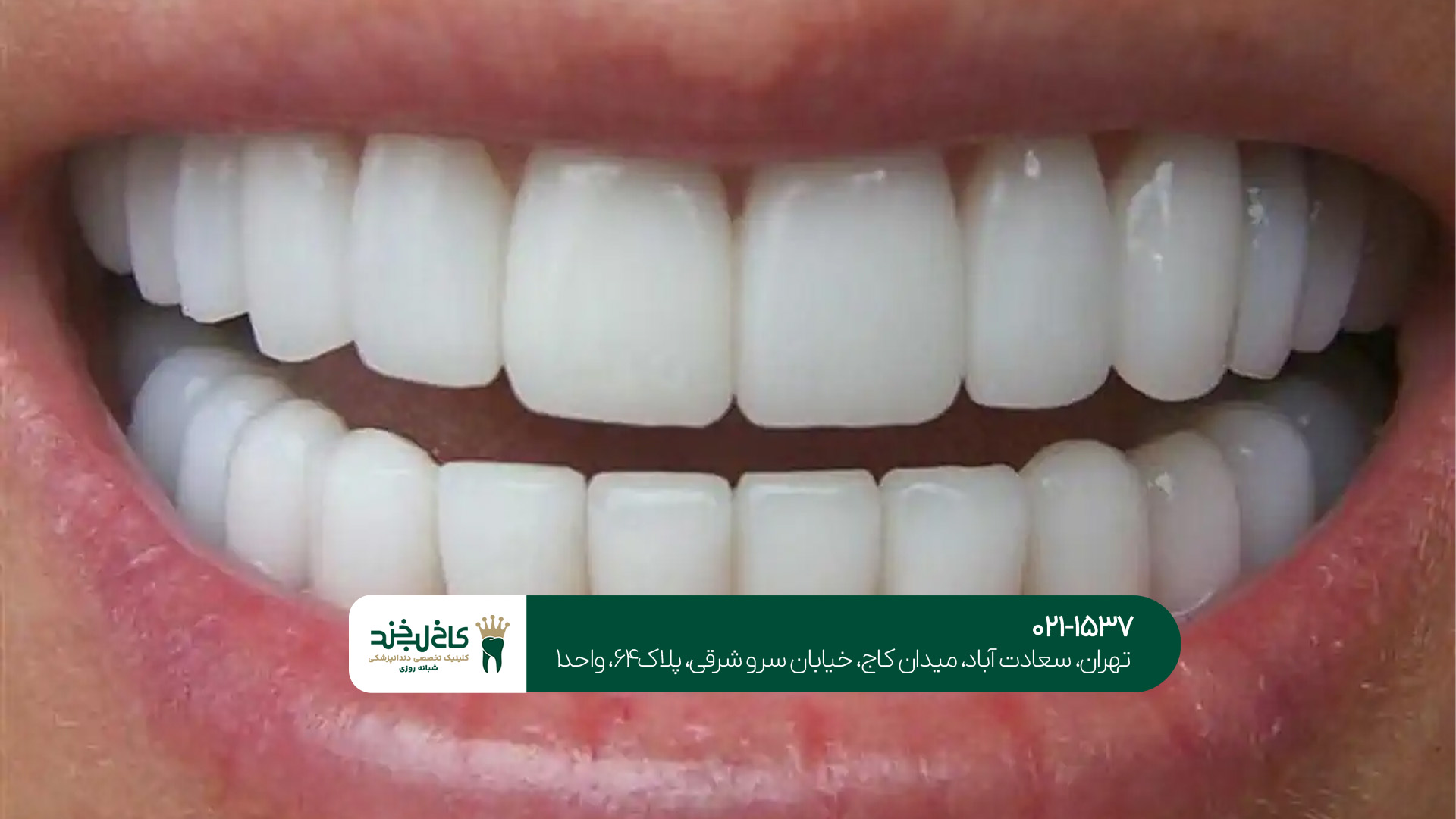 تعریف کامپوزیت و لمینت دندان