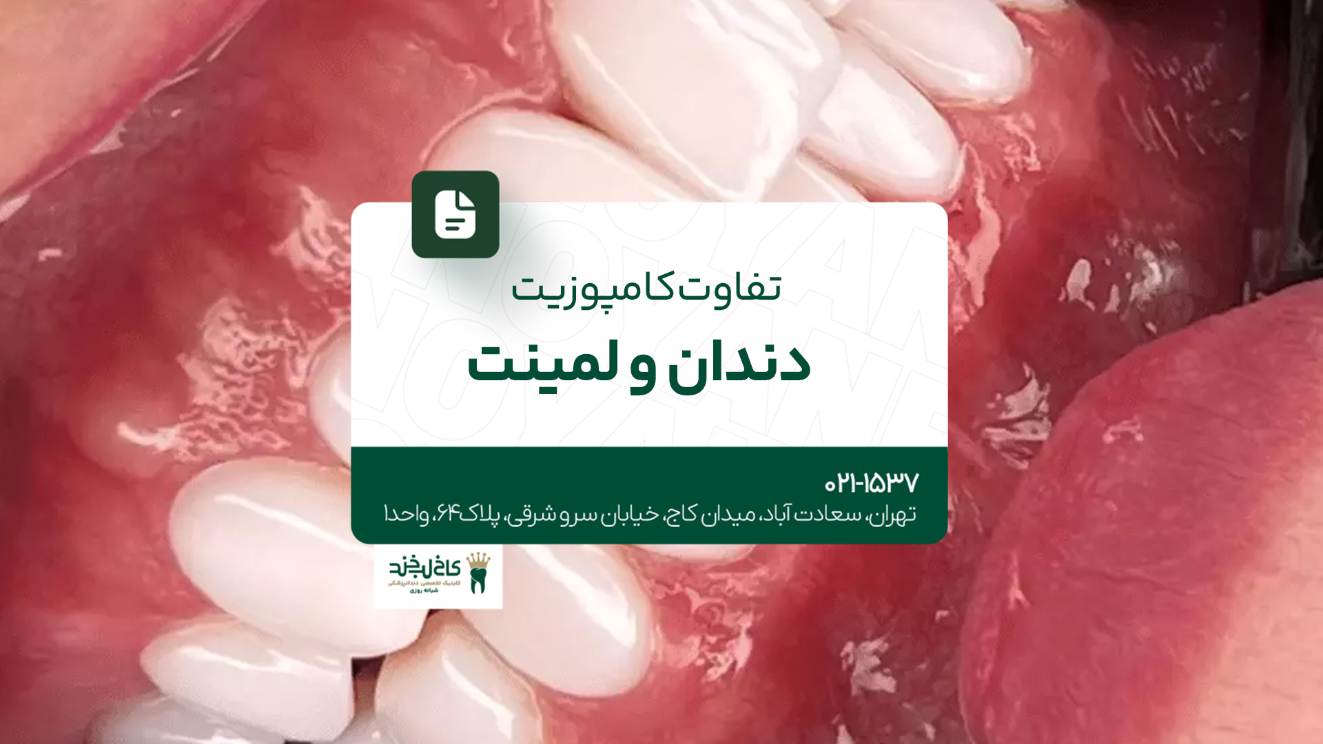 تفاوت کامپوزیت دندان و لمینت