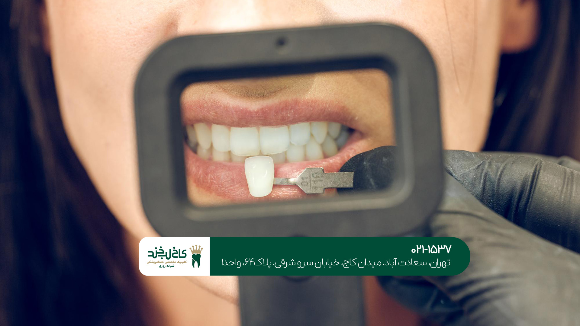 چگونه بهترین دندانپزشکی روکش در تهران را پیدا کنیم؟!