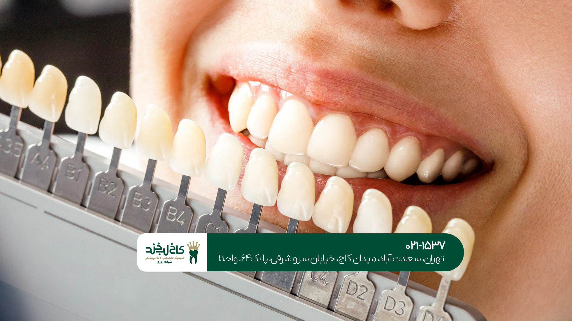 انواع مختلف روکش