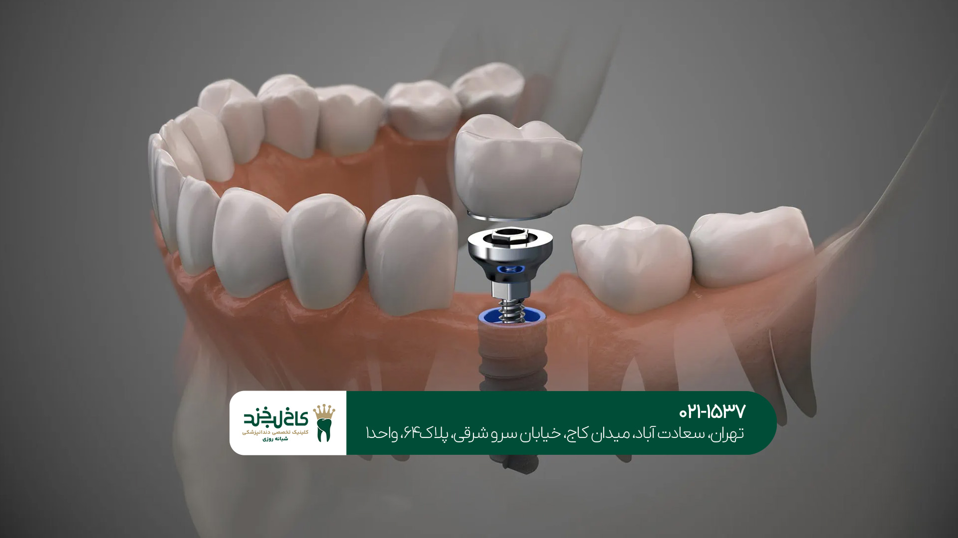 قرارگیری مناسبتر تاج دندان