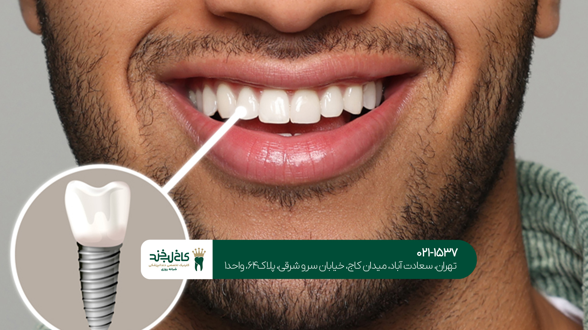 کاشت ایمپلنت یک روزه چگونه انجام میشود؟!