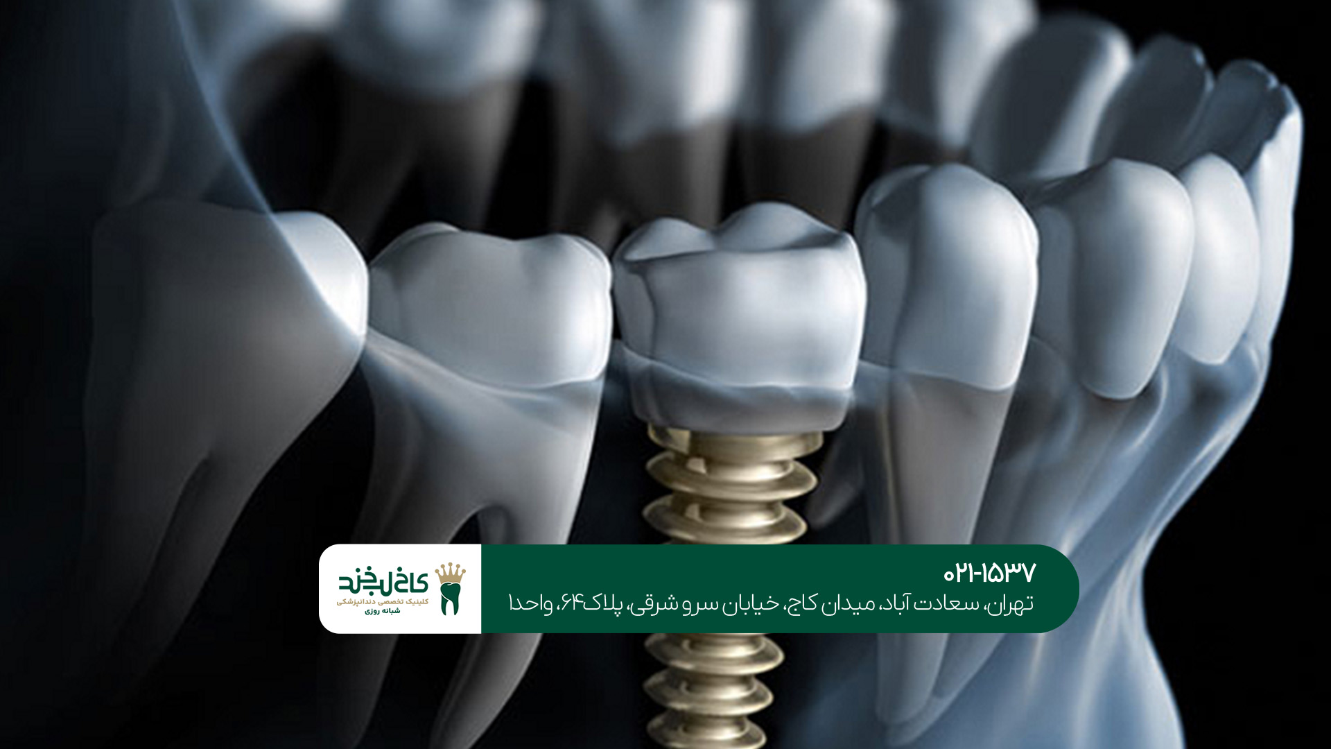 بهترین برند ایمپلنت سوئیسی چیست؟!