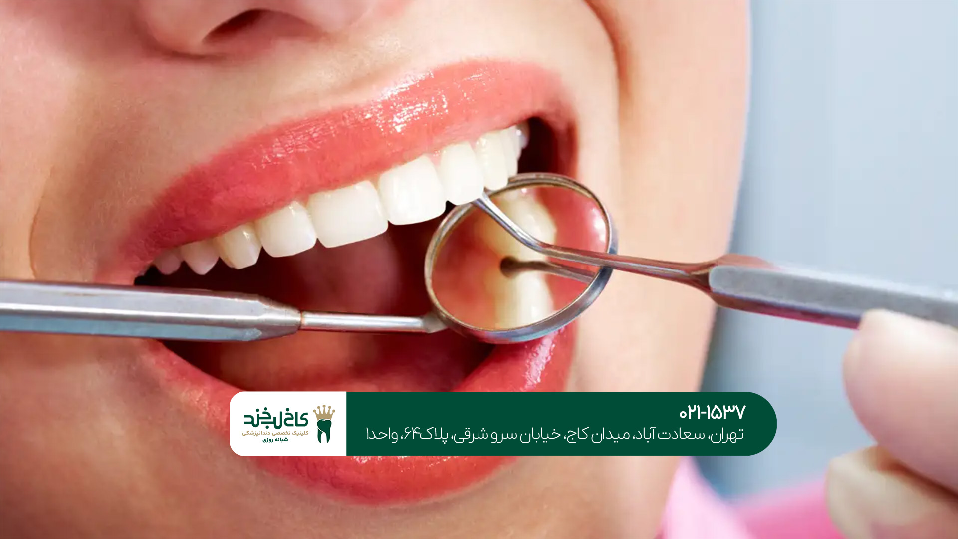 بلیچینگ دندان 