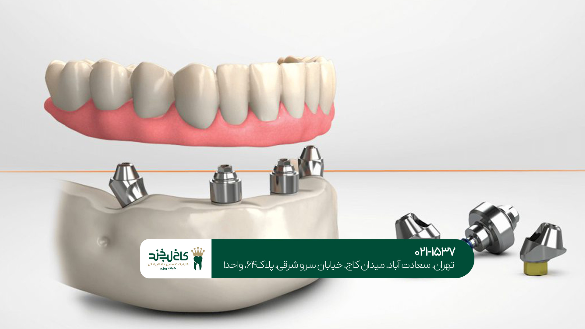 عوامل تاثیرگذار در انتخاب بین ایمپلنت و دندان مصنوعی