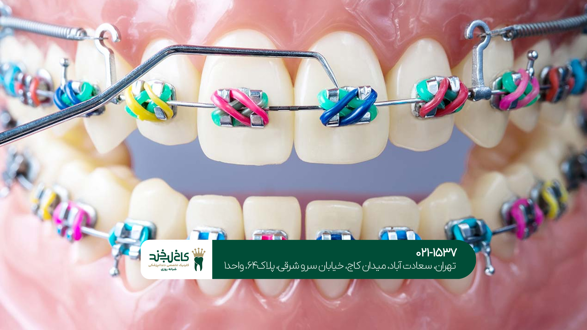 کامپوزیت دندان 