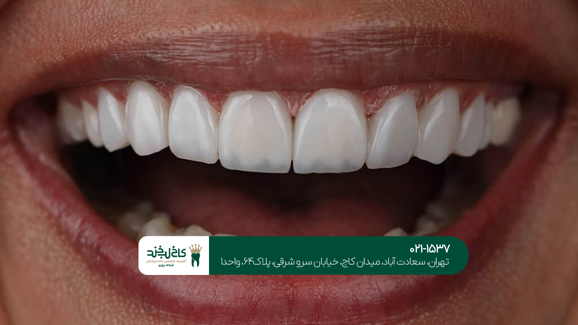 انتخاب دندانپزشک کامپوزیت دندان در سعادت آباد
