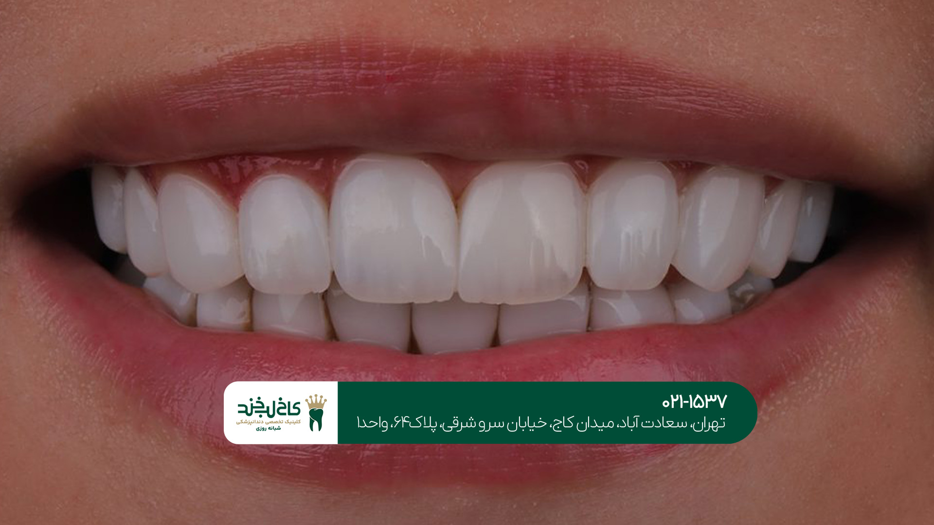 هزینه کامپوزیت دندان در سعادت آباد چقدر است؟!