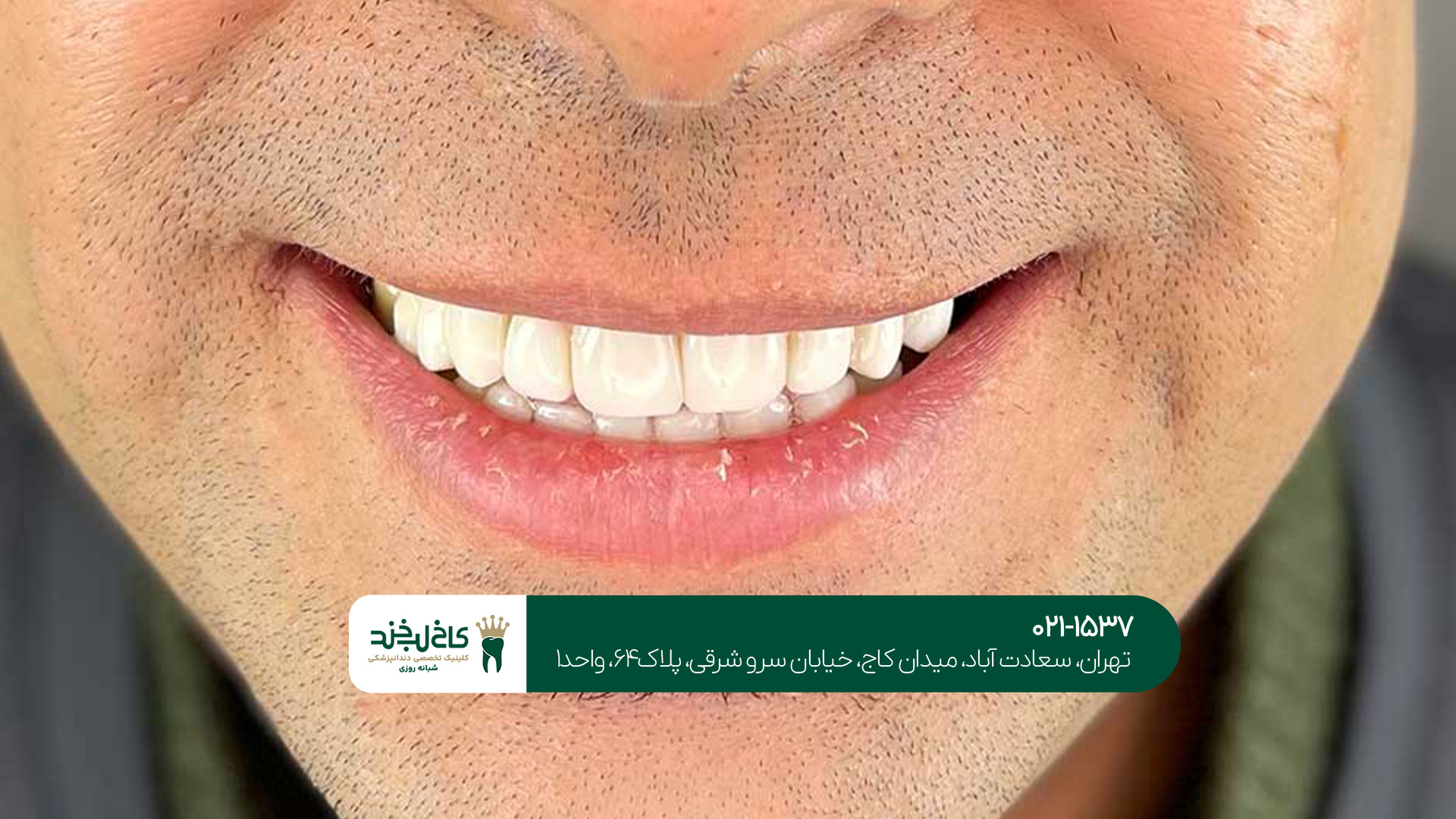 مراقبت‌های بعد از انجام کامپوزیت دندان در سعادت آباد 