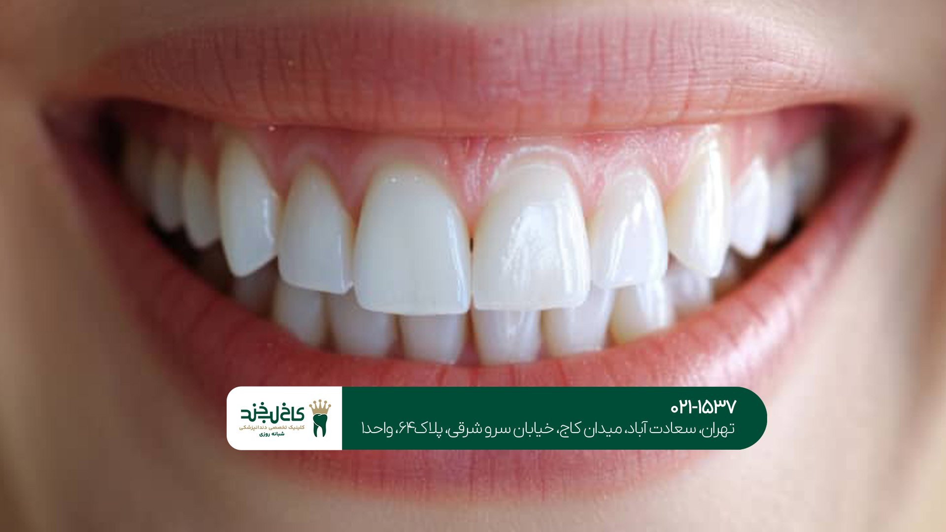 یلیچینگ دندان در شمال تهران