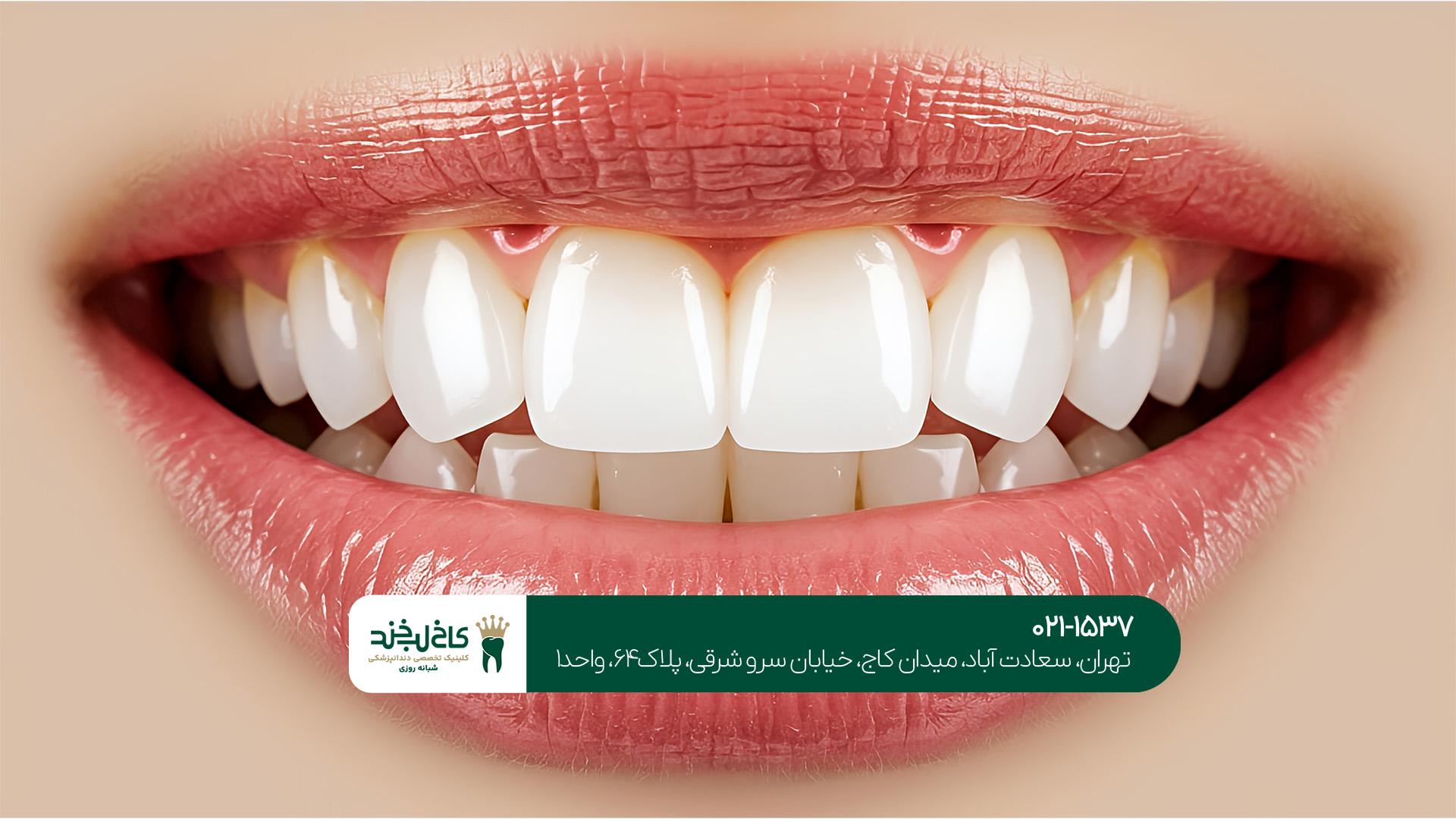 بلیچینگ دندان در شمال تهران