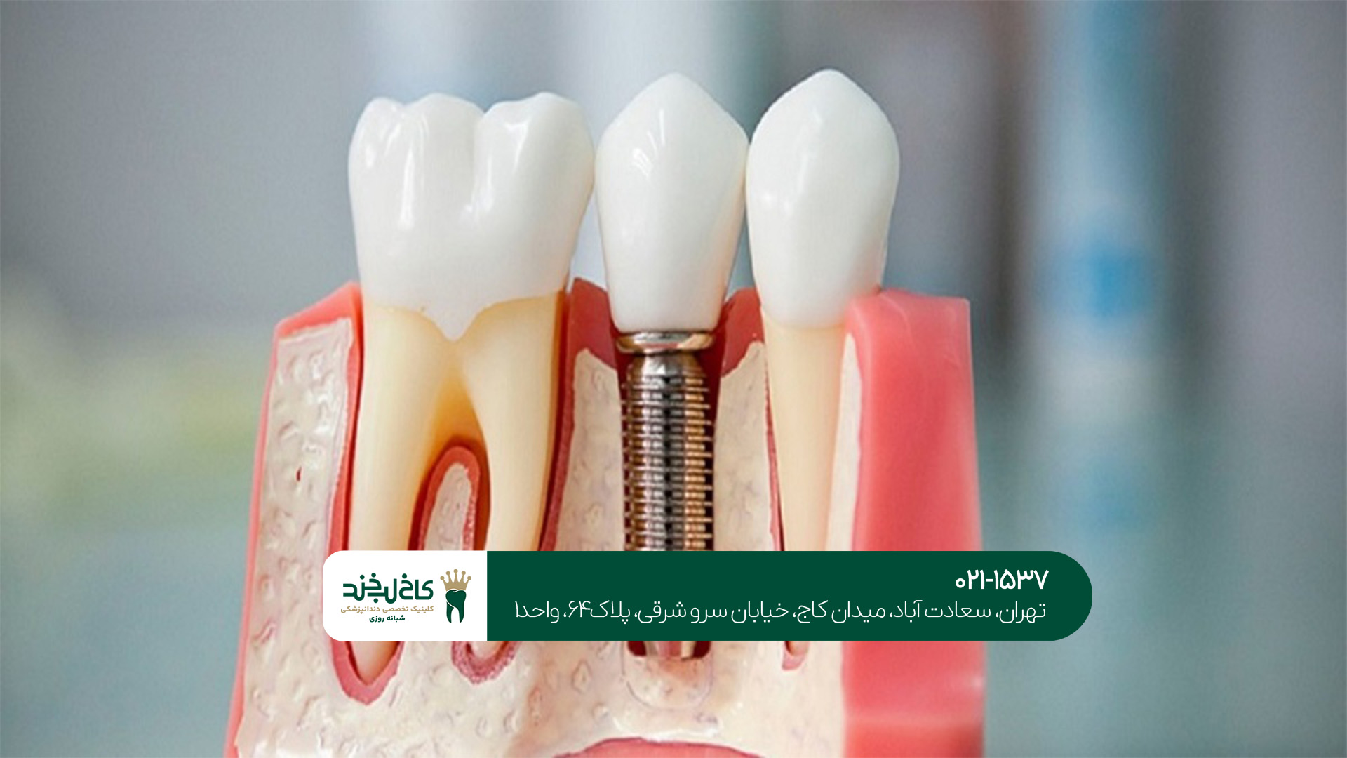 بهترین ایمپلنت دندان در تهران