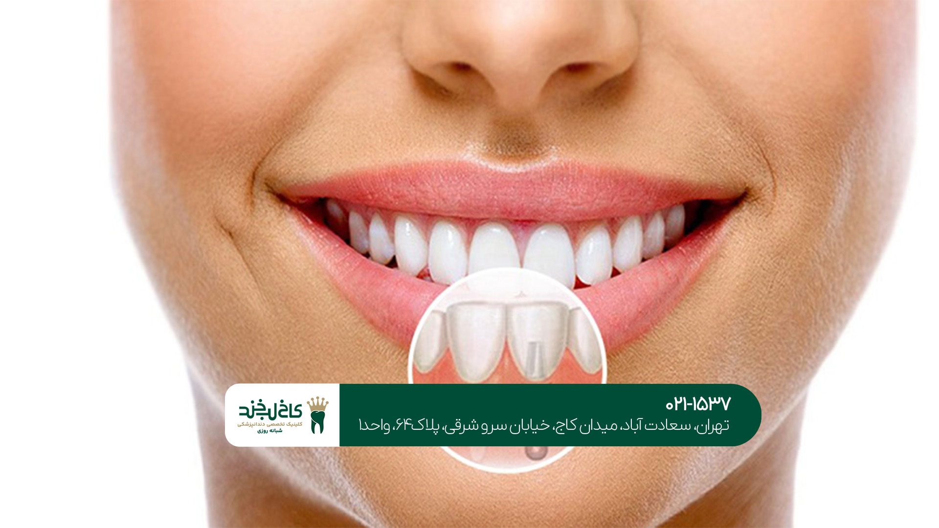 بهترین ایمپلنت دندان در تهران