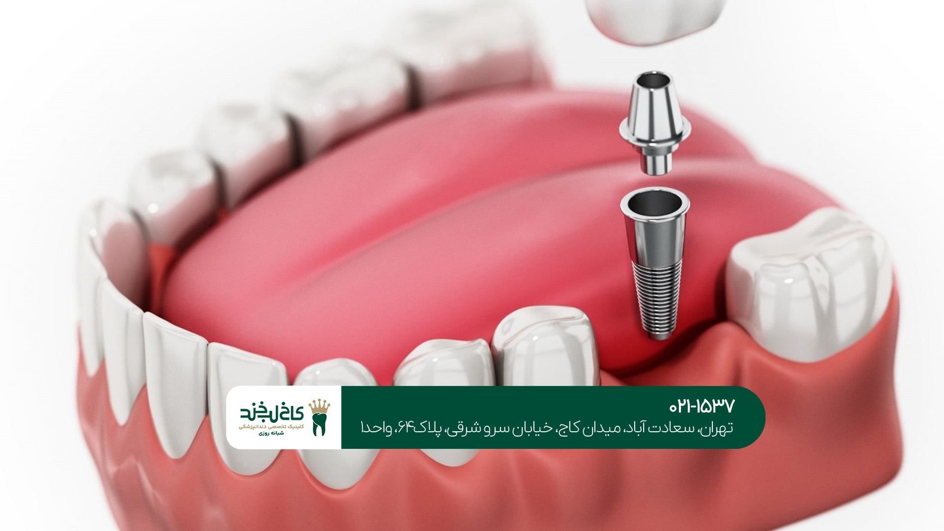 بهترین ایمپلنت دندان در تهران