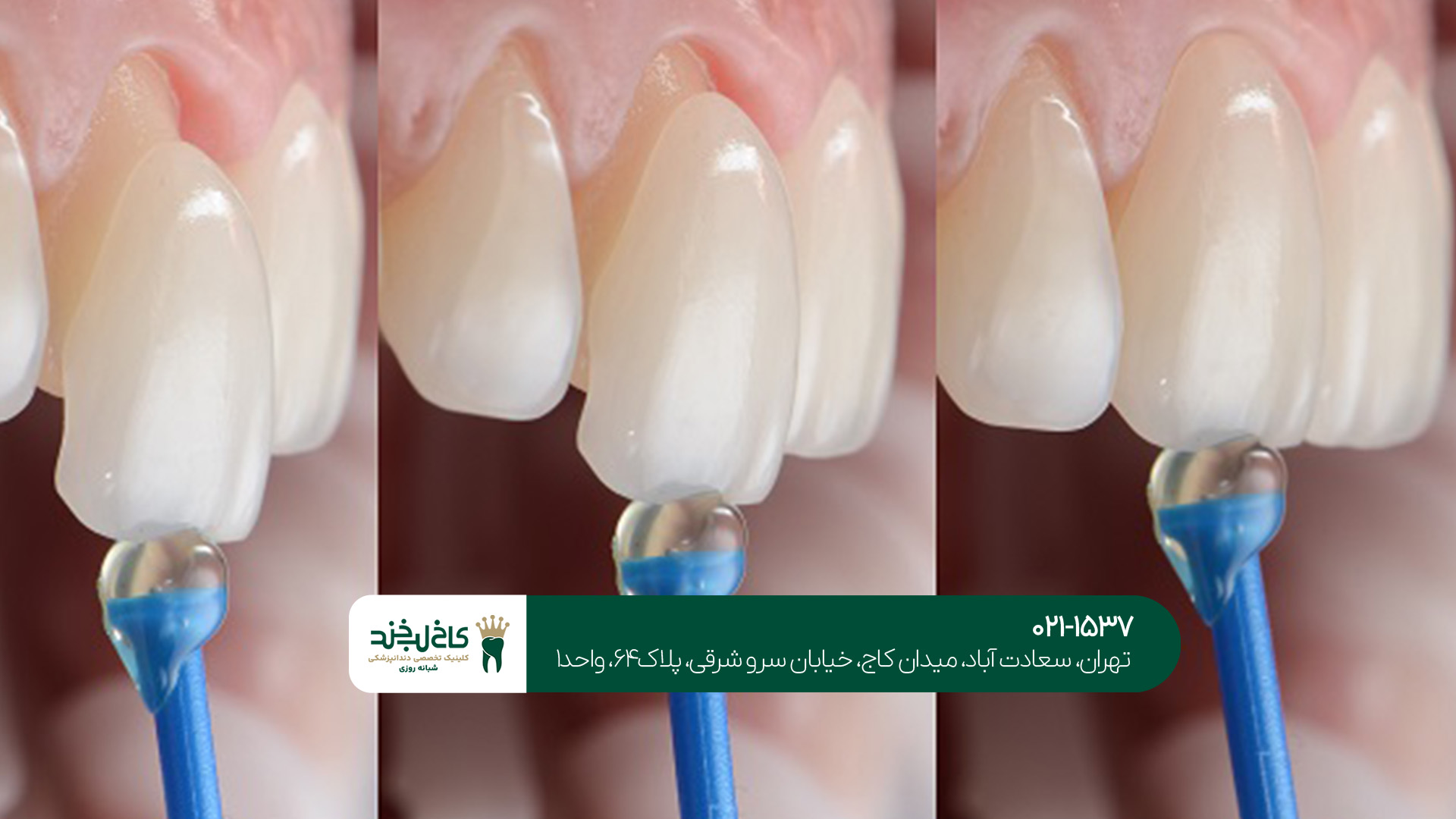 مراحل بهترین لمینت دندان تهران