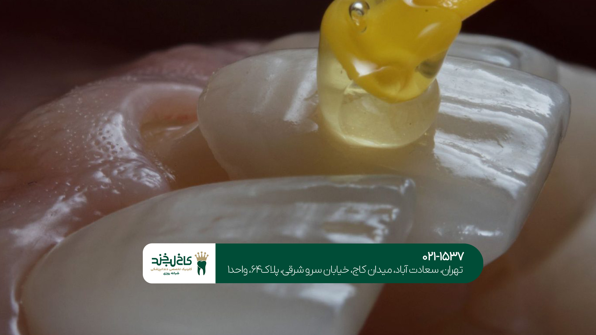 بهترین لمینت دندان تهران چه مزایایی دارد؟!