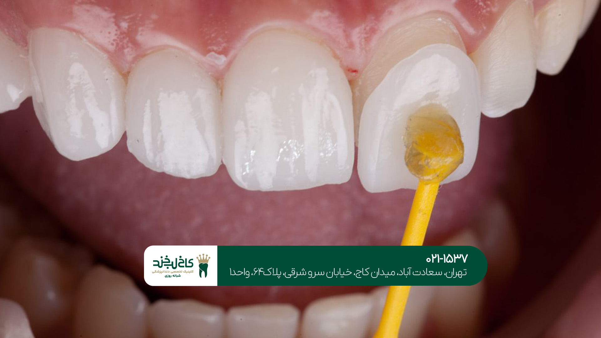 انواع لمینت چیست؟!