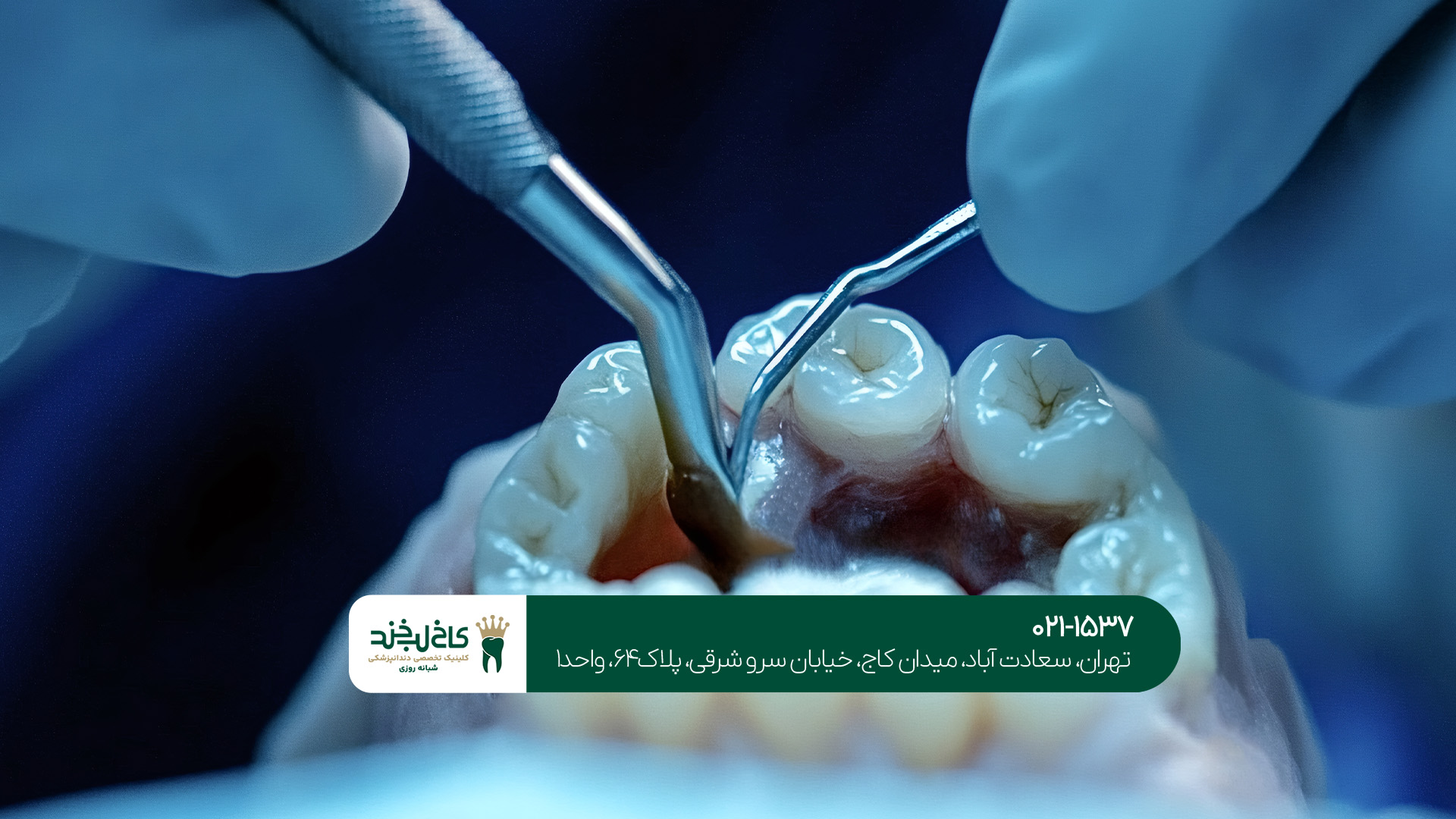 عصب کشی دندان در تهران چه زمانی باید انجام شود؟!