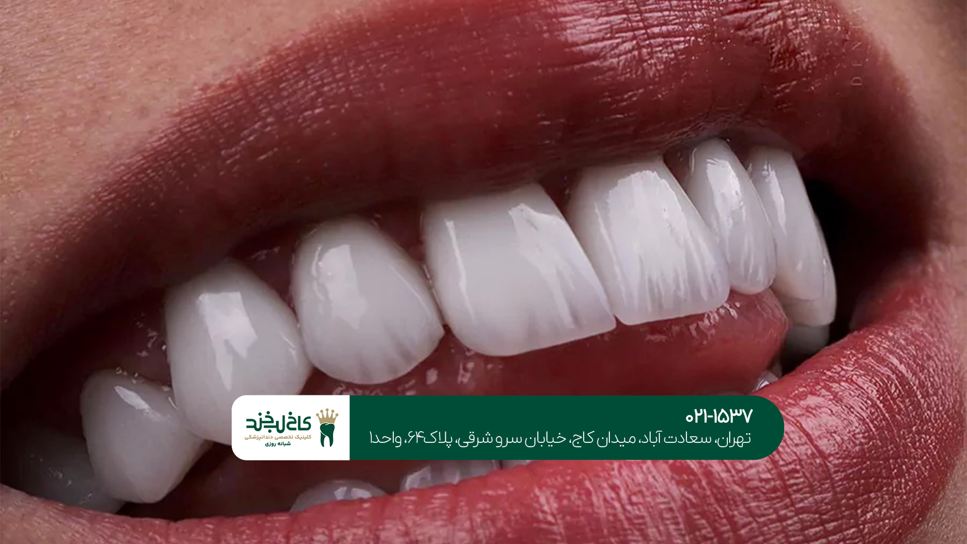 شرایط انجام لمینت دندان در تهران چیست؟!
