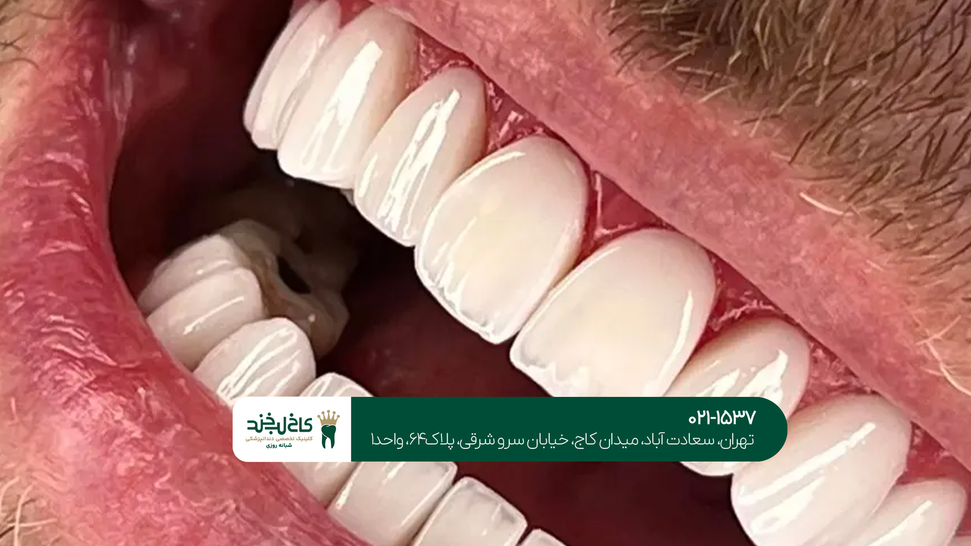 لمینت دندان چه انواعی دارد؟!