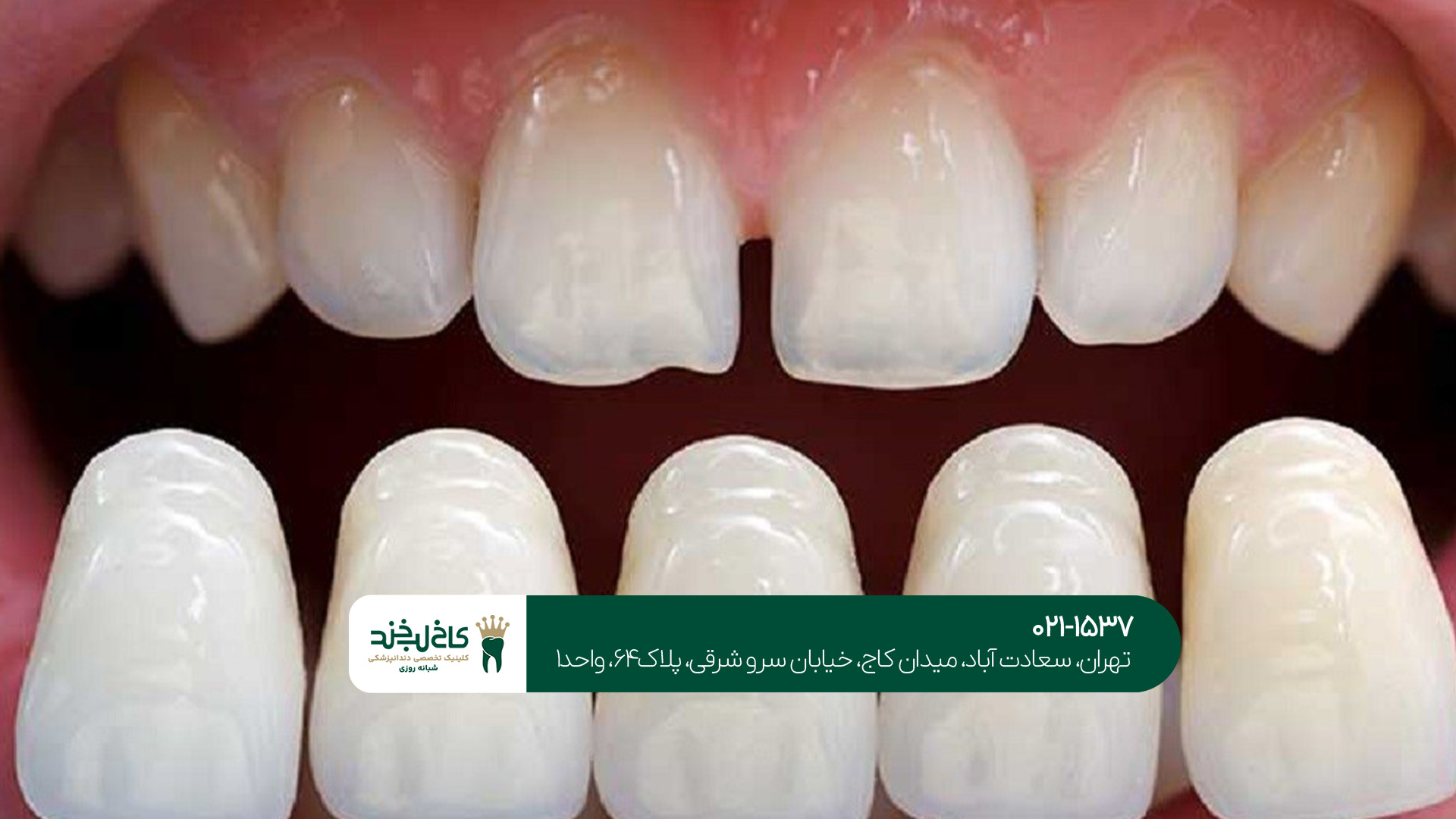 نکات مراقبتی بعد از انجام لمینت دندان در تهران