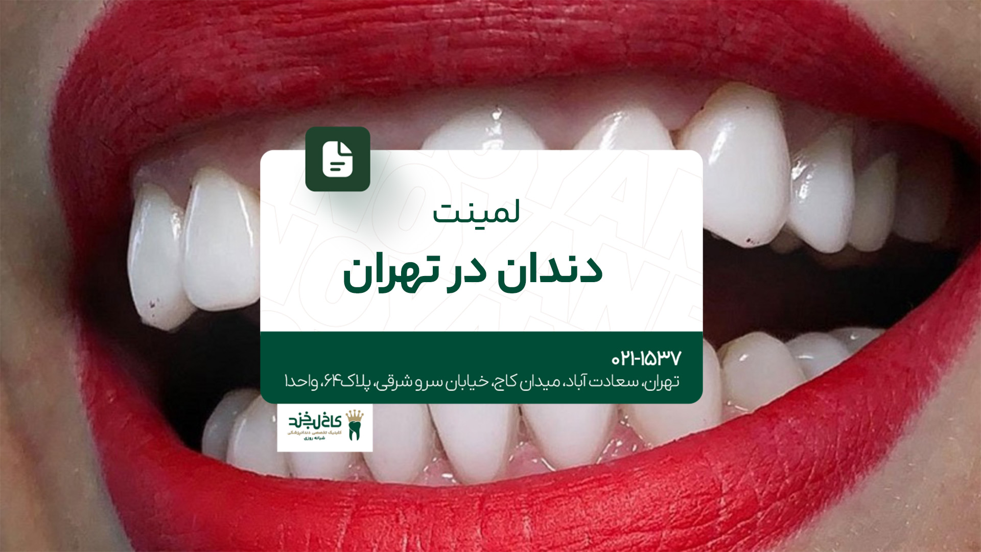 لمینت دندان در تهران