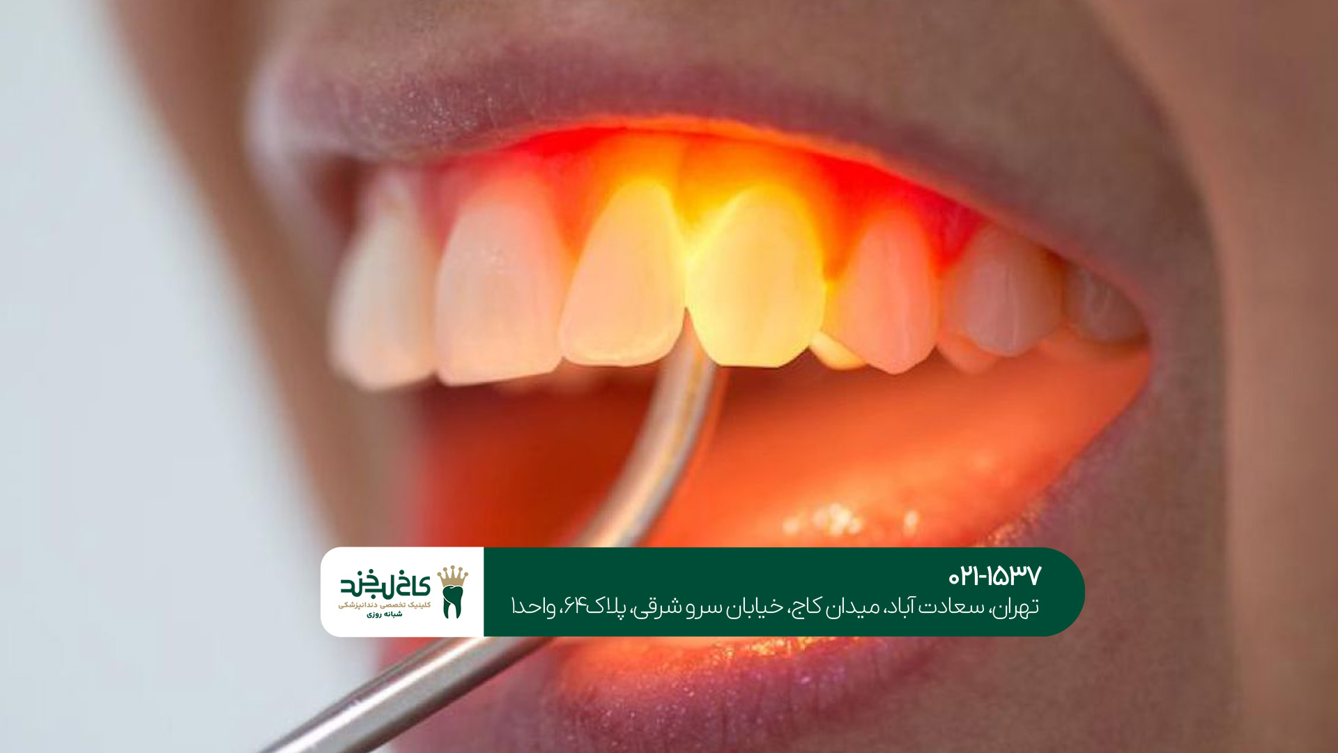 کامپوزیت دندان چه انواعی دارد؟!