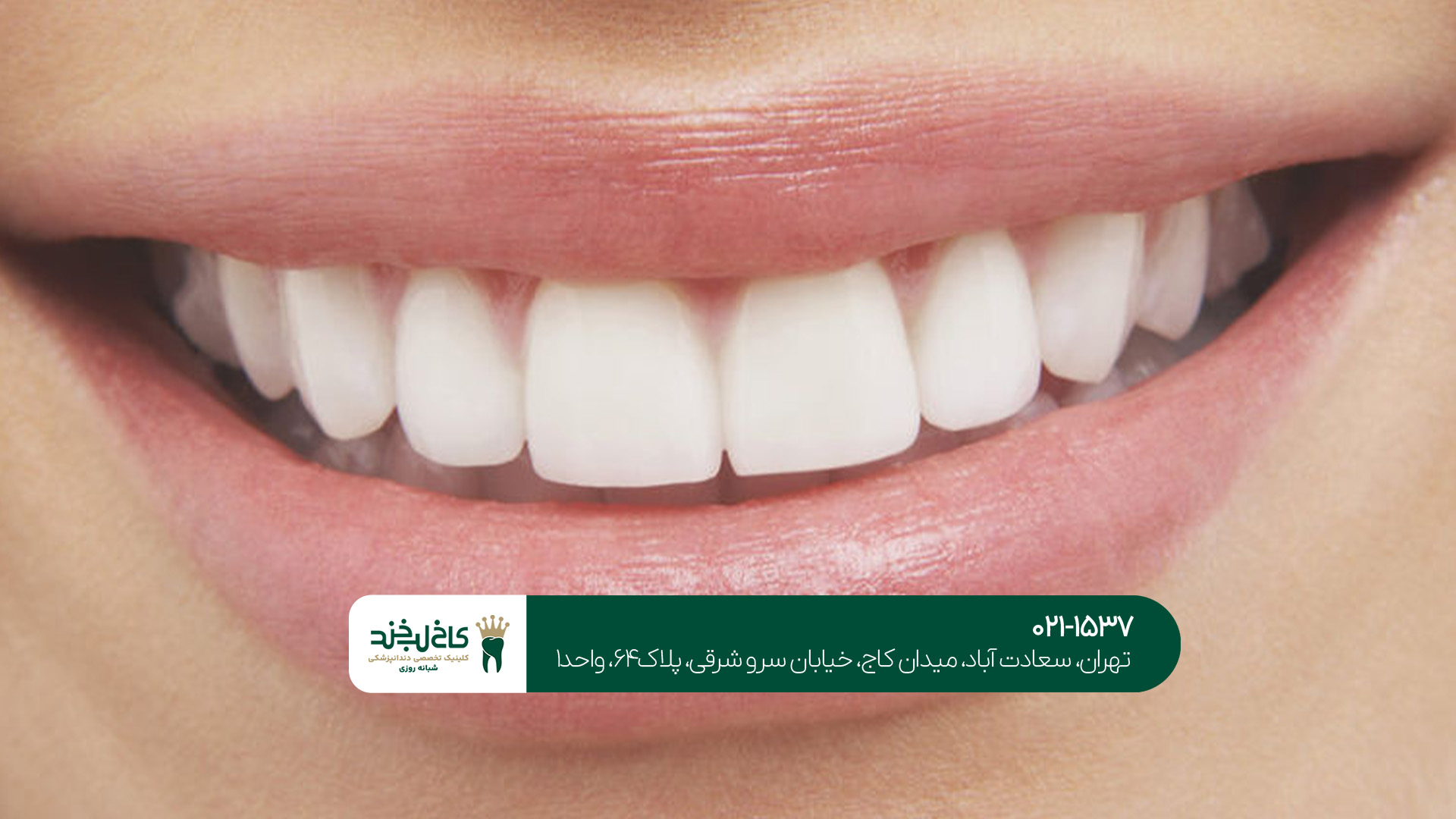 نکات مهم درباره لمینت دندان در شمال تهران 