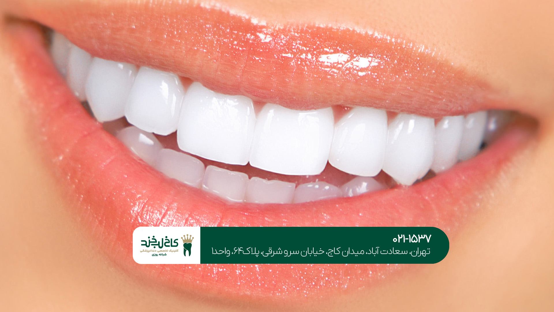 برای انجام لمینت دندان در شمال تهران به کدام کلینیک دندانپزشکی مراجعه کنیم؟!