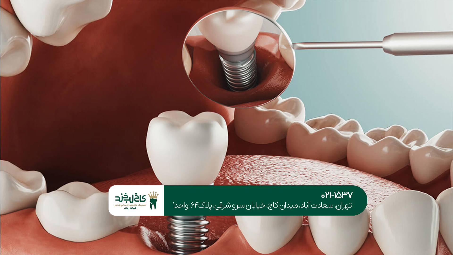 ایمپلنت دندان چه اجزایی دارد؟