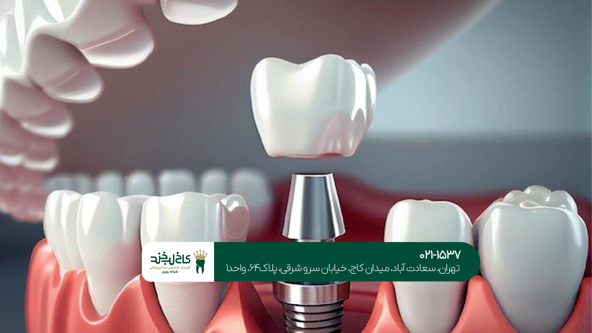 بهترین دندانپزشک ایمپلنت در تهران باید چه ویژگیهایی داشته باشد؟!