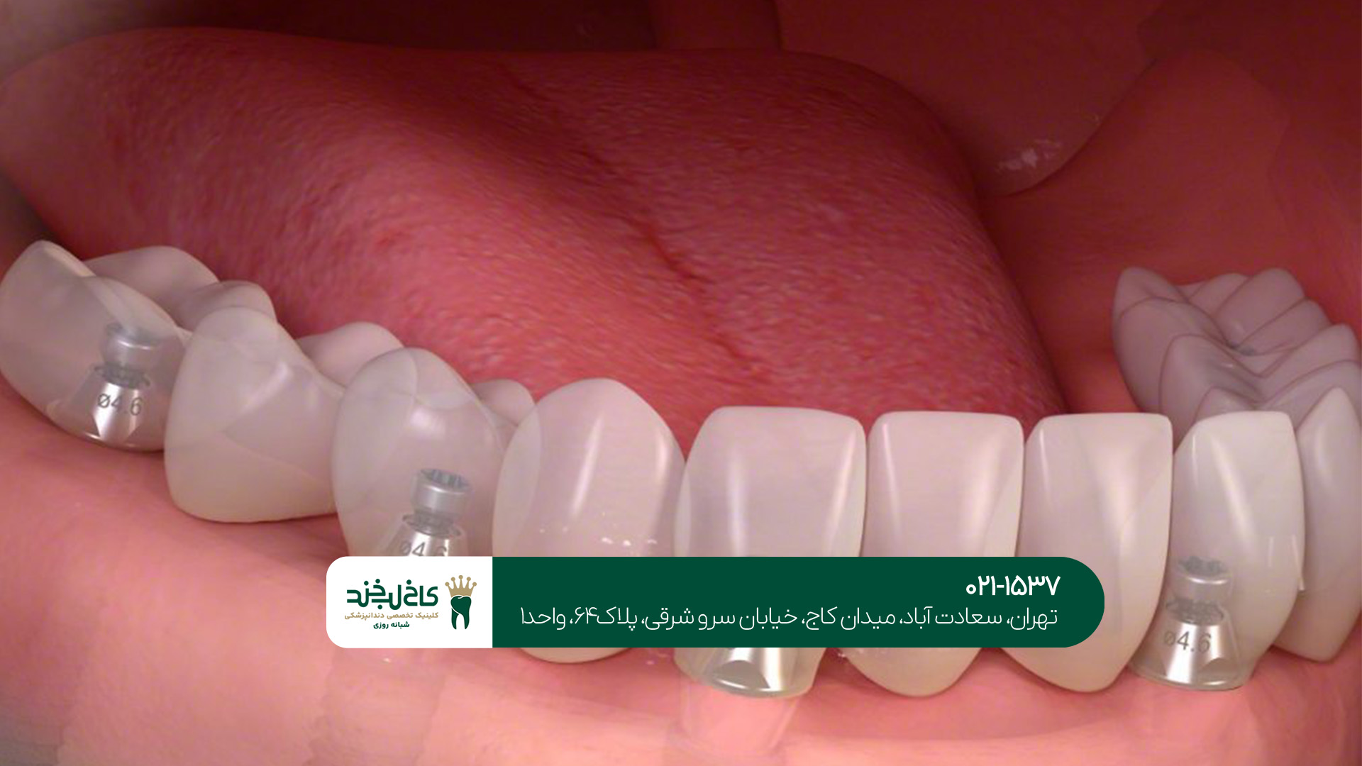 هزینه ایمپلنت دندان چقدر است؟!