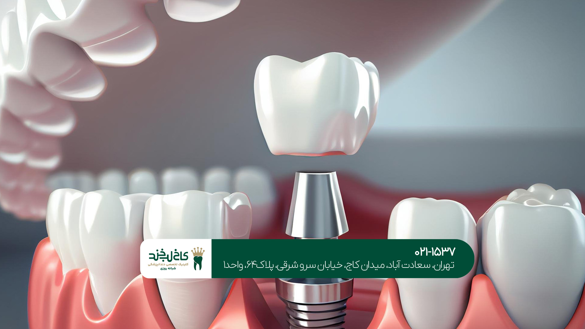 ایمپلنت دندان چیست؟