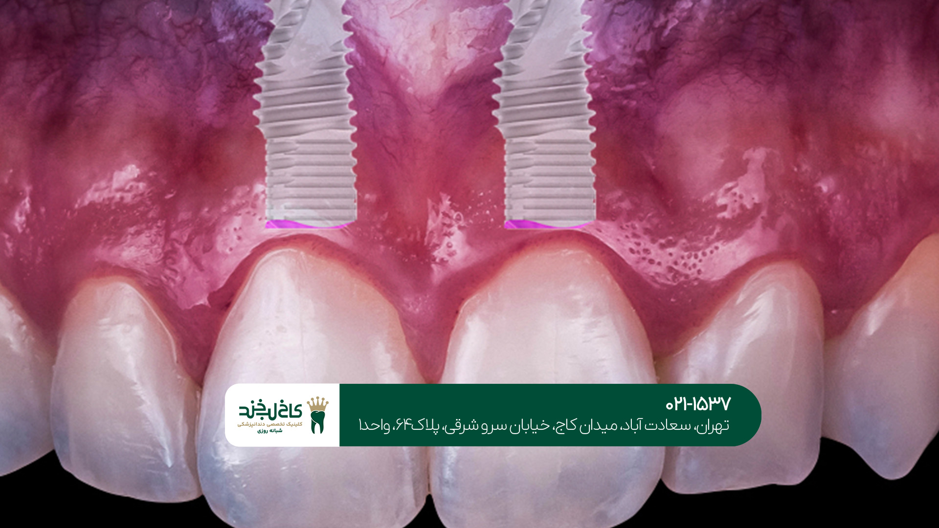 ایمپلنت دندان