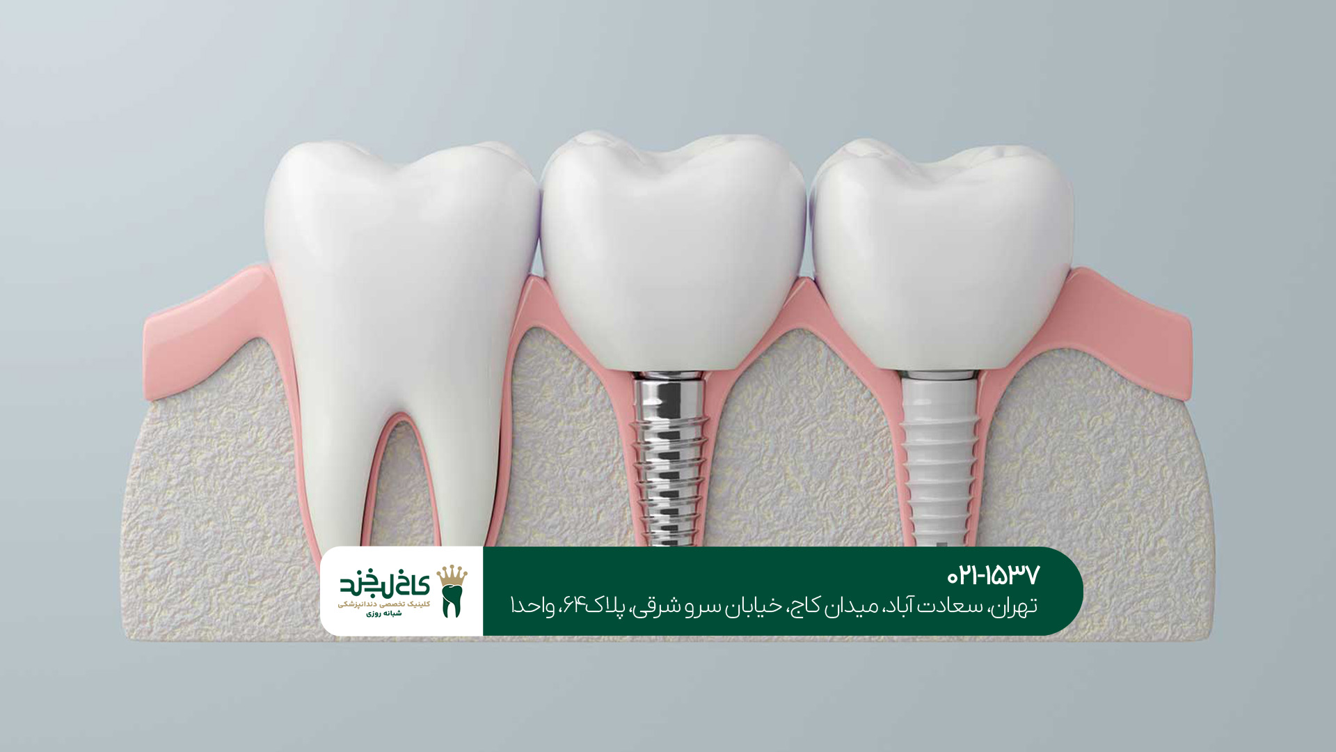 انواع مختلف ایمپلنت دندان