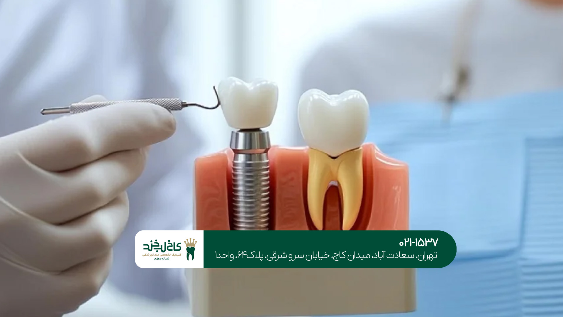 ایمپلنت دیجیتال در تهران ایمپلنت دیجیتال در تهران