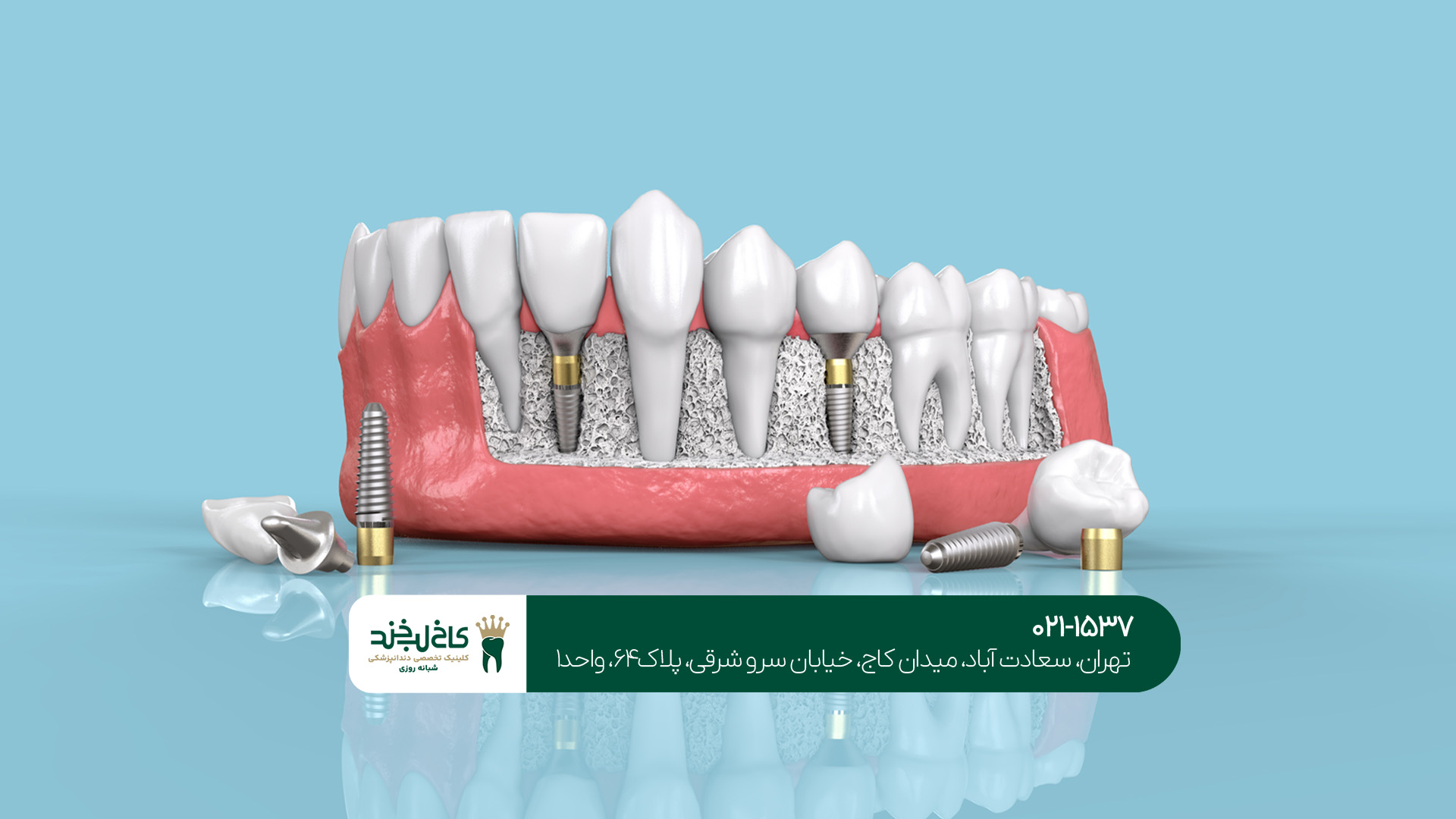 ایمپلنت دیجیتال در تهران ایمپلنت دیجیتال در تهران