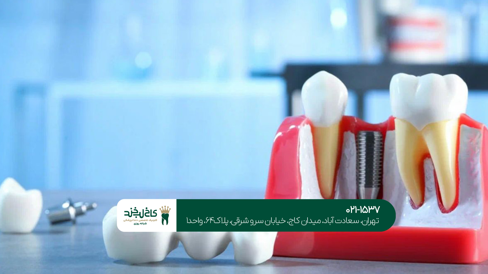 ایمپلنت دیجیتال در تهران ایمپلنت دیجیتال در تهران