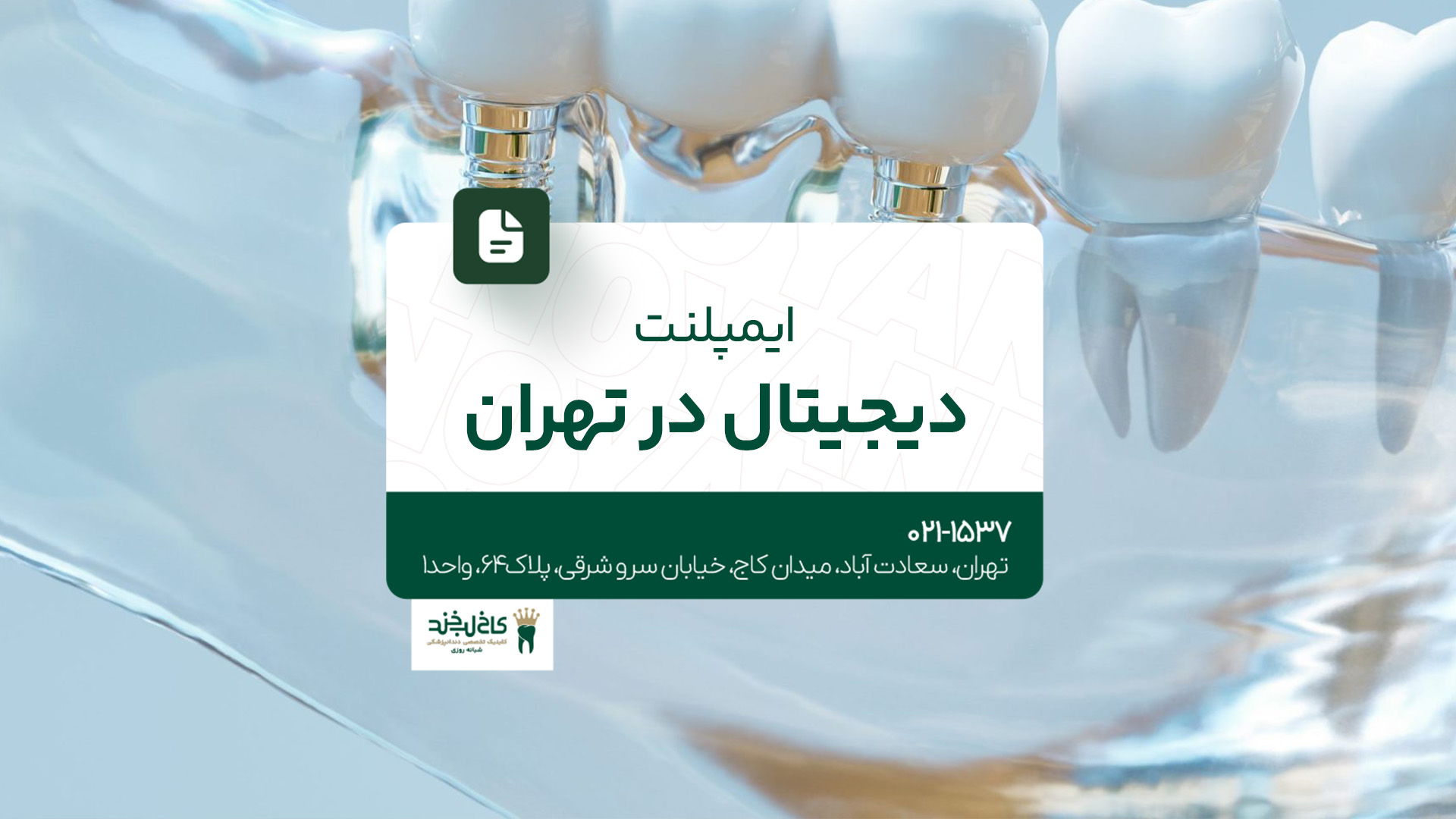 ایمپلنت دیجیتال در تهران ایمپلنت دیجیتال در تهران